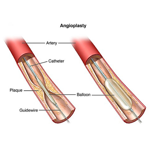 coronary-angioplasty-doctor