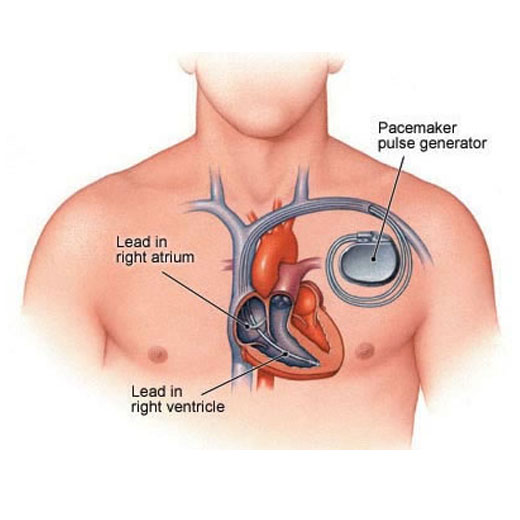 pacemaker-implantation-doctor